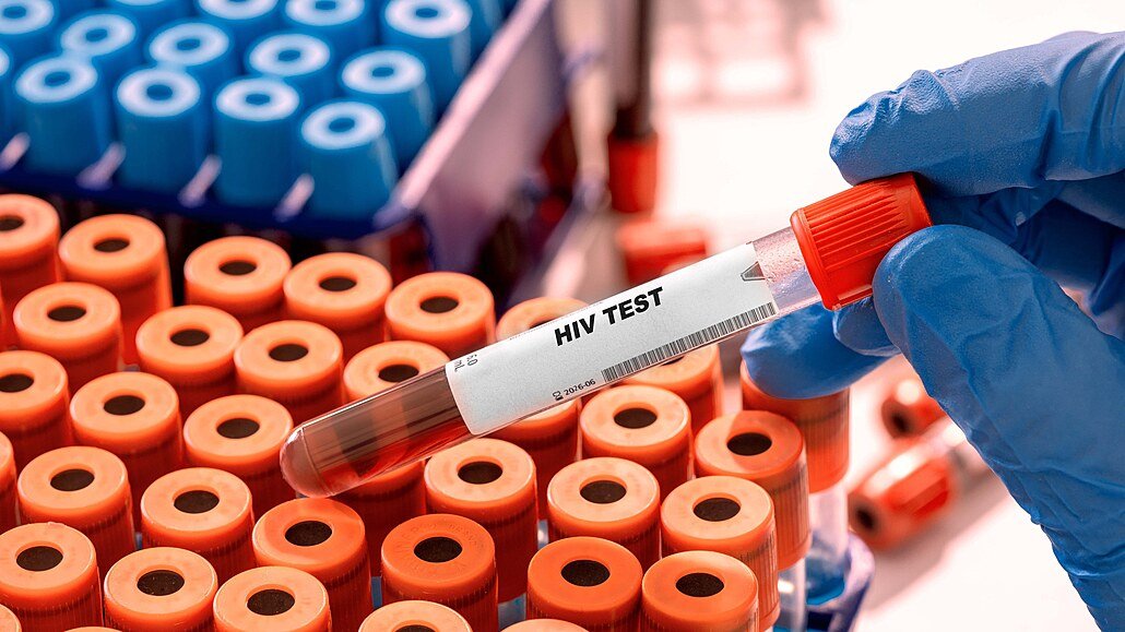 HIV v Česku dál přibývá. Případy nejsou jen ve velkých městech, týkají se i Zlínského kraje